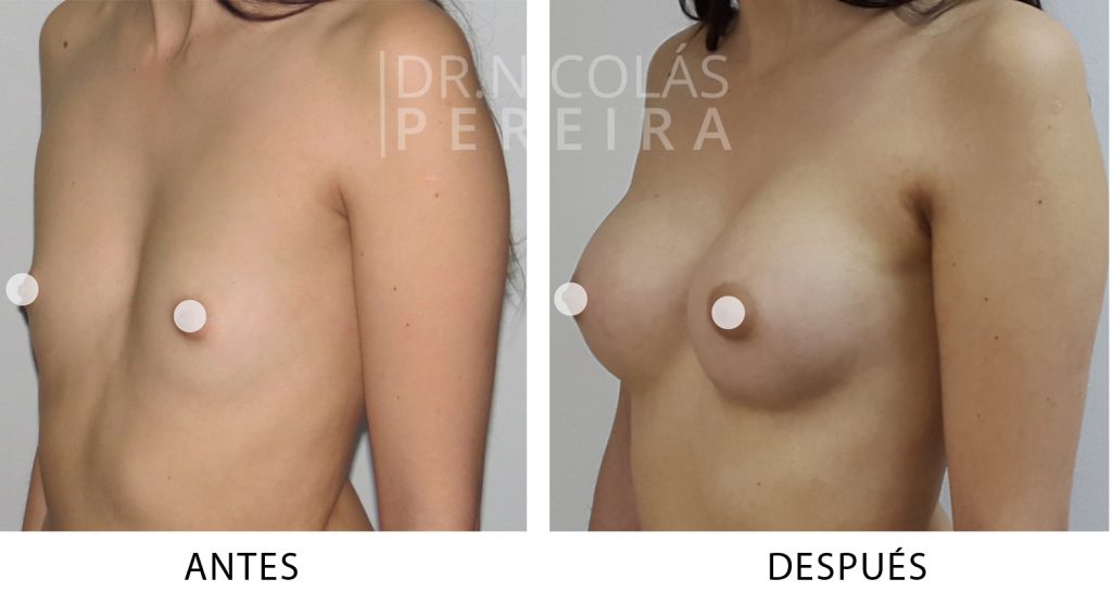 aumentomamario