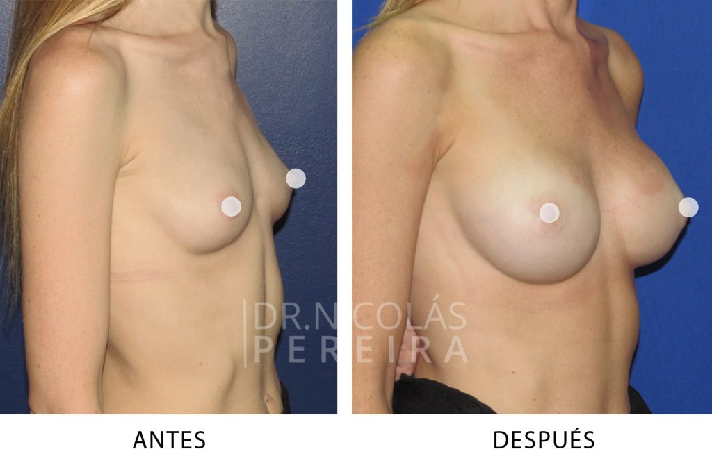 aumentomamario_002