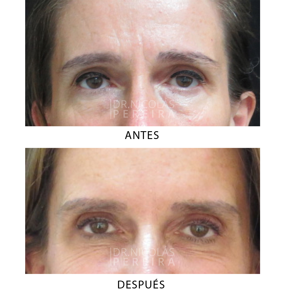 botox_OK
