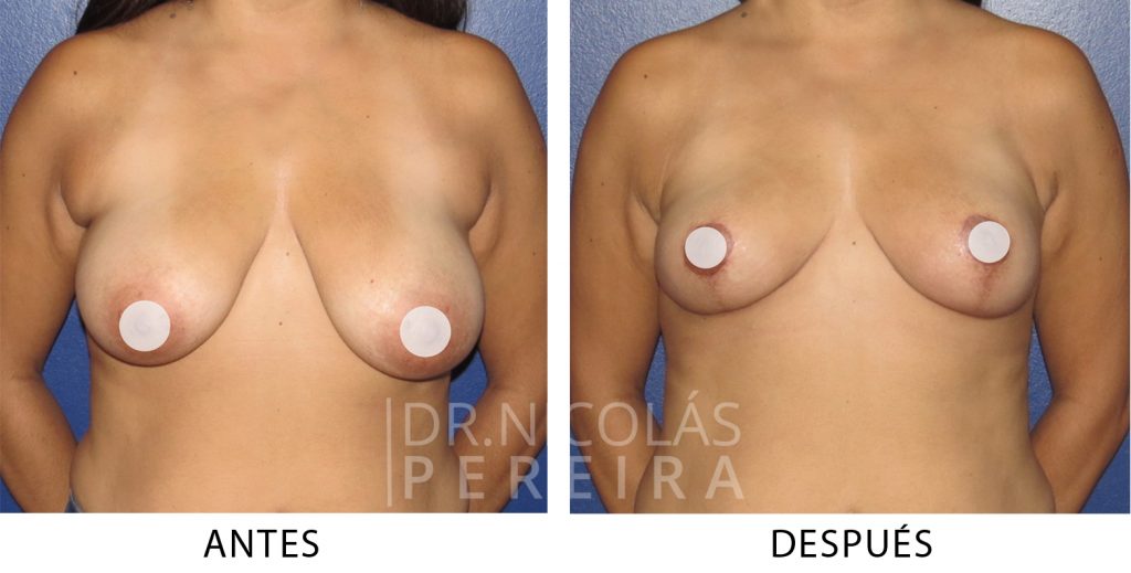 mastopexia