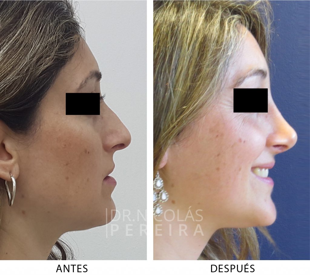 rinoplastia