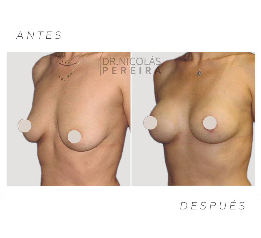 foto-antes-y-despues-mastopexia-ok