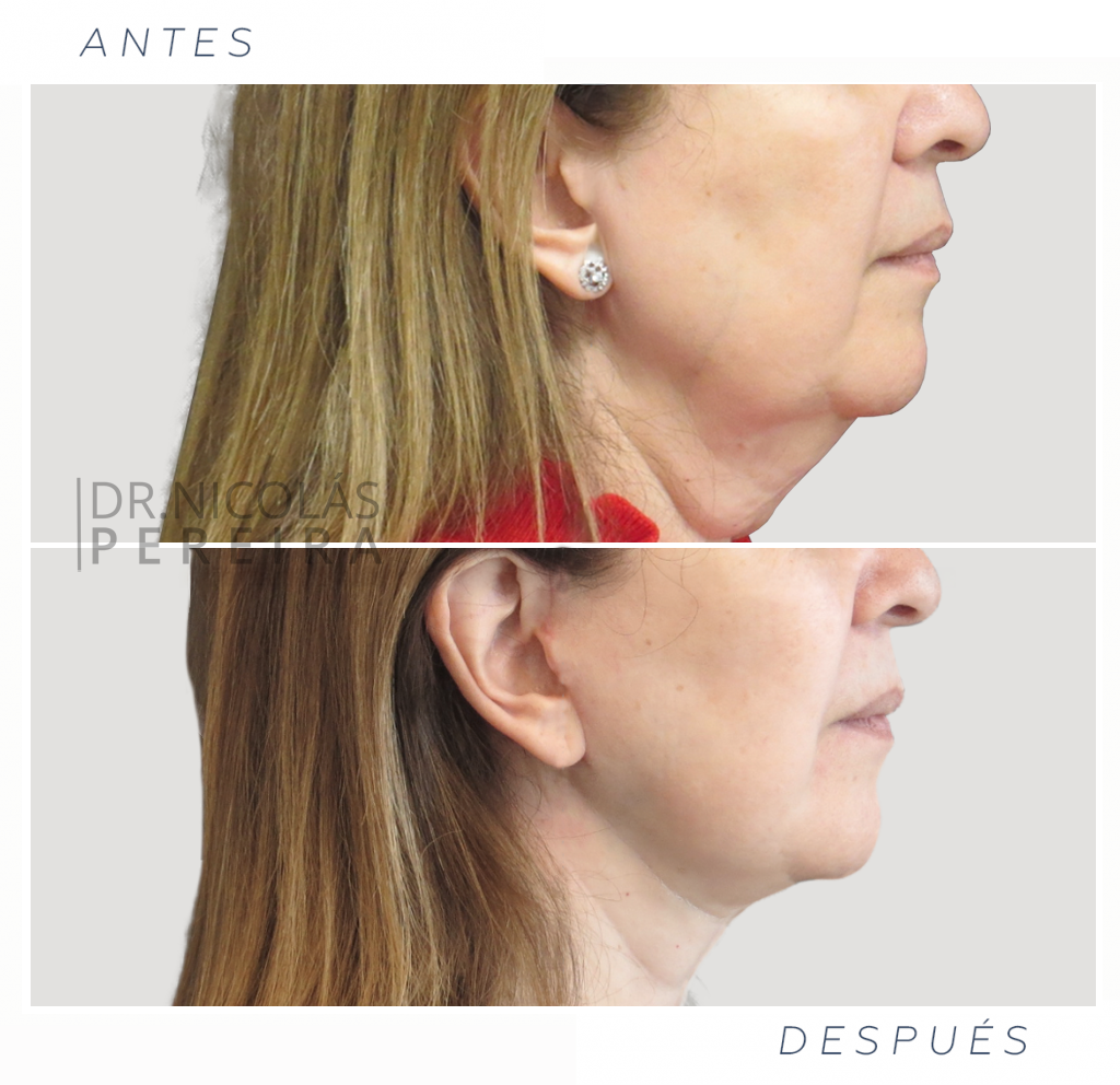 lifting-facial-08-ok