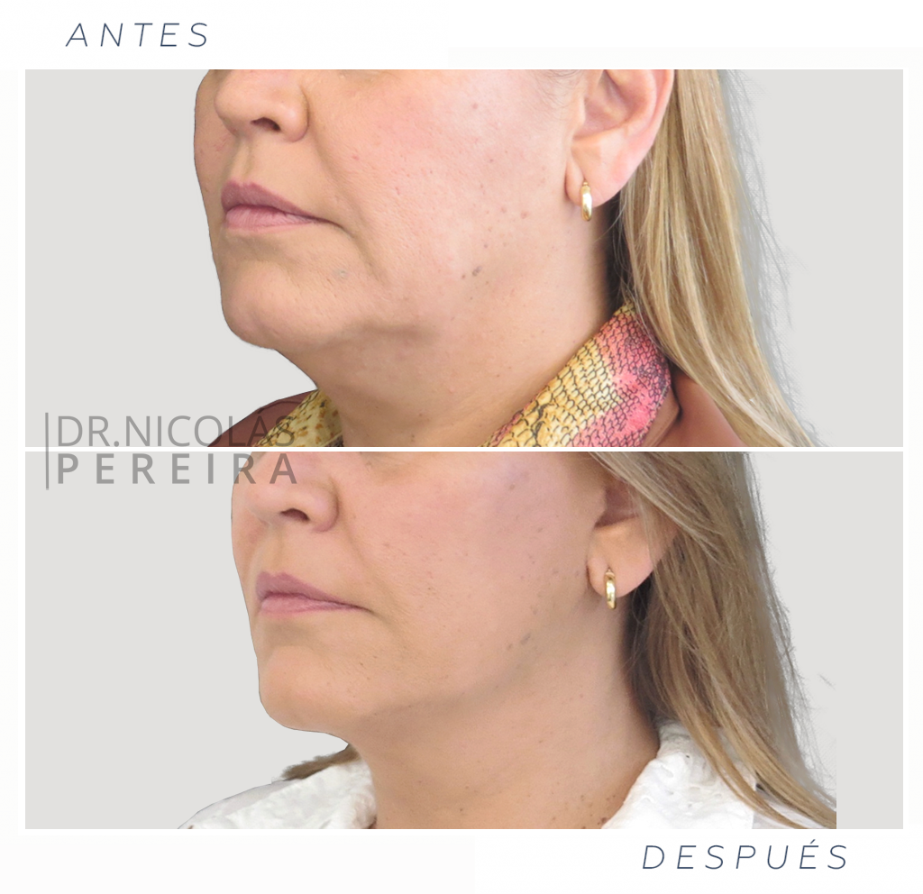 linfting-facial07-ok