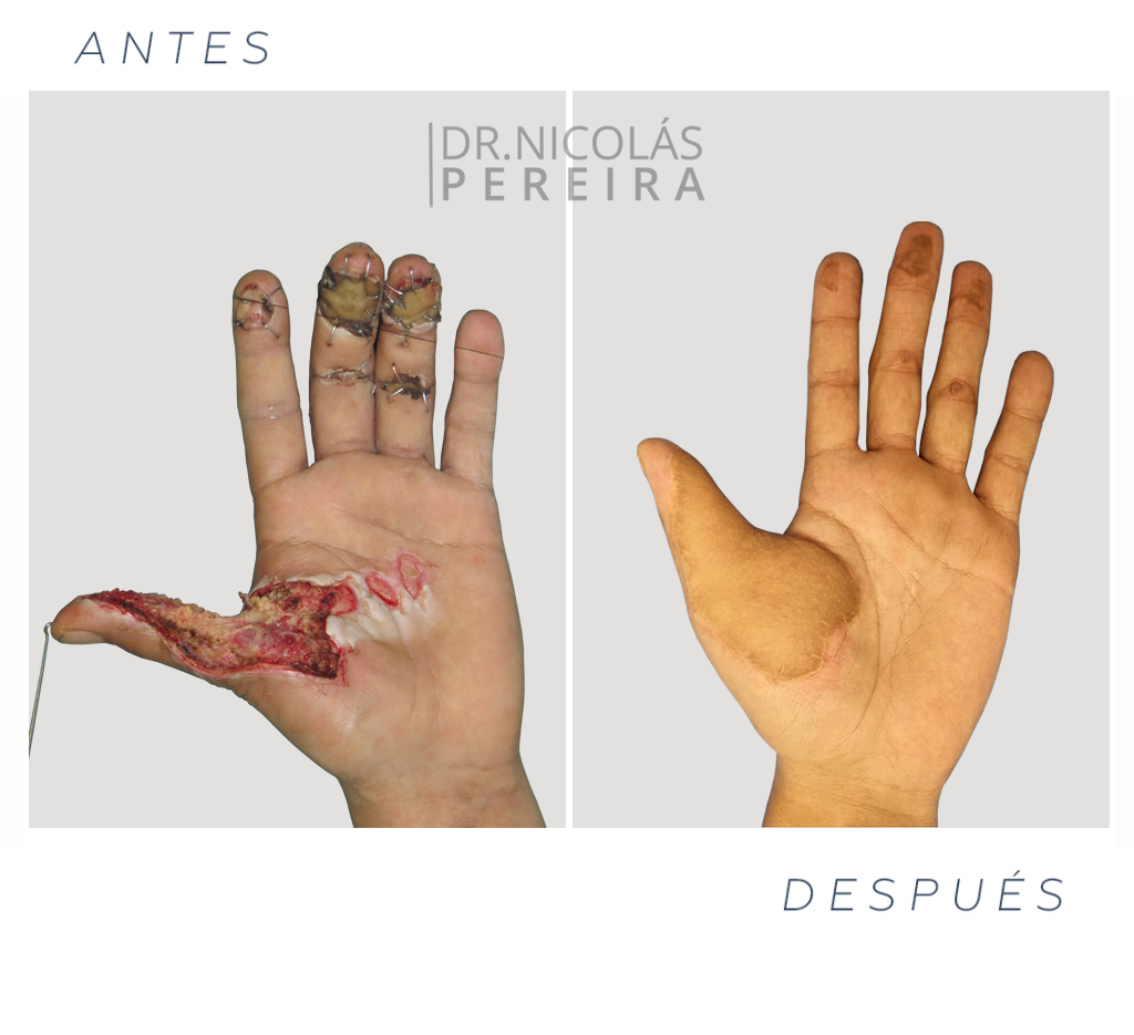 mano-herida-ok