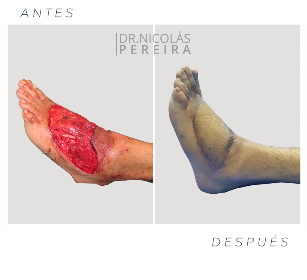 pie-herido-ok